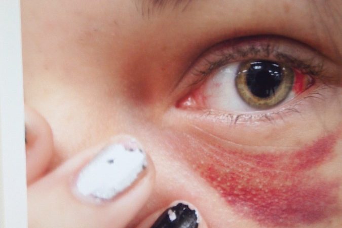 Close-up of an eye with a visible bruise underneath. Close-up of an eye with a visible bruise underneath.
